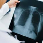 Dove buttare lastre radiografiche