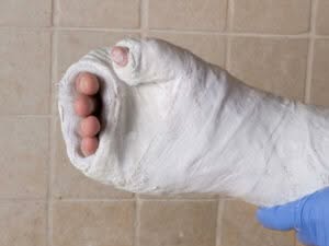 gesso per frattura realizzato in vetroresina